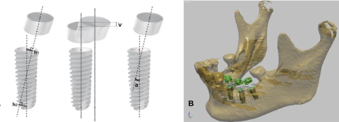 Table 1. Deviations between surgical guide bushings and placed implants from pre- and post-op CBCT data