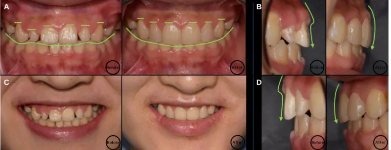 Fig. 30. Comparison of before and after treatment. (A) Frontal view, (B) Right lateral view, (C) Maxillary anterior view, (D) Left lateral view