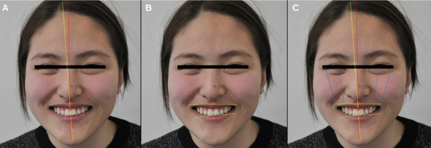 Fig. 1. Initial extra-oral photographs in frontal view. (A) Facial midline with the midline of central incisors, (B) Horizontal parameters relating the inter-pupillary line to the incisal edge position, (C) Full-facial analysis.