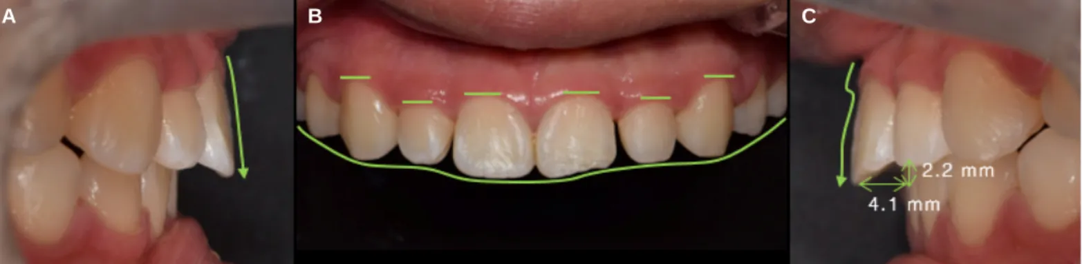 Fig. 5. Analysis of smile line at initial visit. (A) Rest state view, (B) Slight smile view, (C) Maximum smile view.