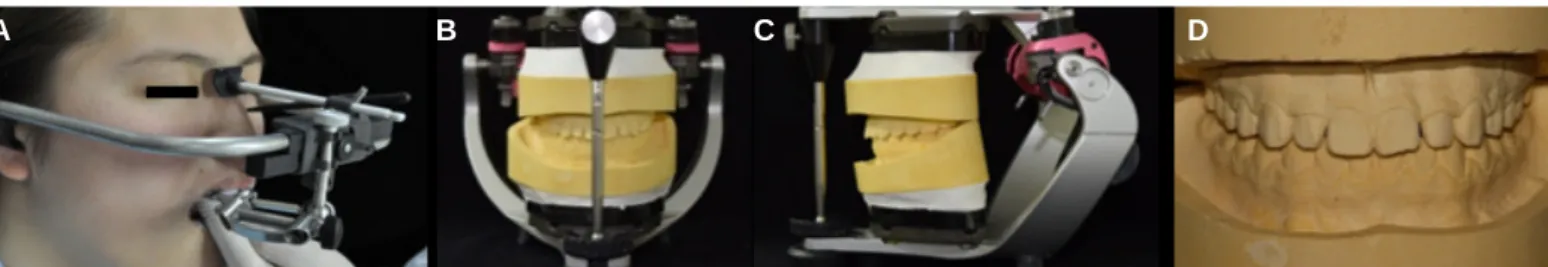 Fig. 7. Semi-articulator mounting procedures. (A) Facebow transfer (B) Mounting the diagnostic model to an articulator in frontal view (C) Mounting the diagnostic mod- mod-el to an articulator in lateral view (D) Diagnostic modmod-el.