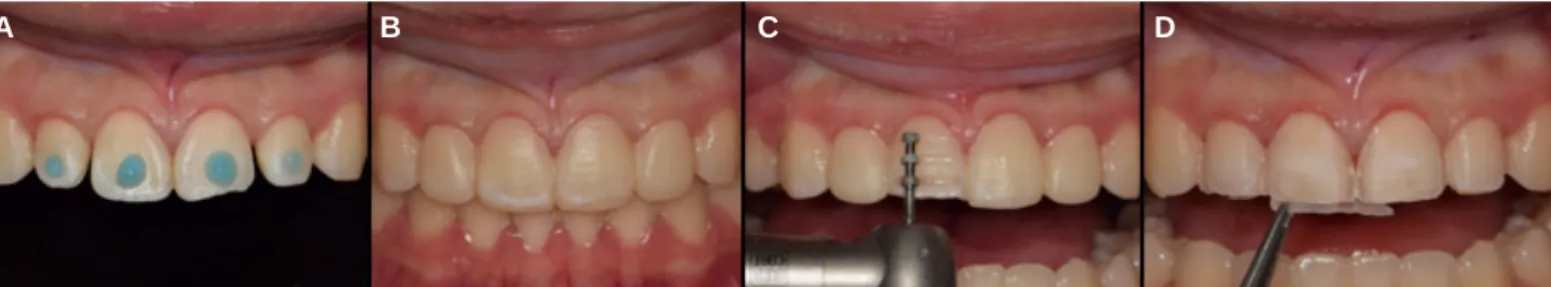 Fig. 12. Mock-up fabrication and abutment preparation. (A) Spot etching, (B) Mock-up fabircation, (C) Abutment preparation, (D) Removal of resin excess.
