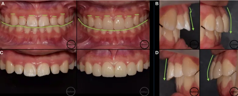 Fig. 16. Comparison of before and after treatment. (A) Frontal view, (B) Right lateral view, (C) Maxillary anterior view, (D) Left lateral view.