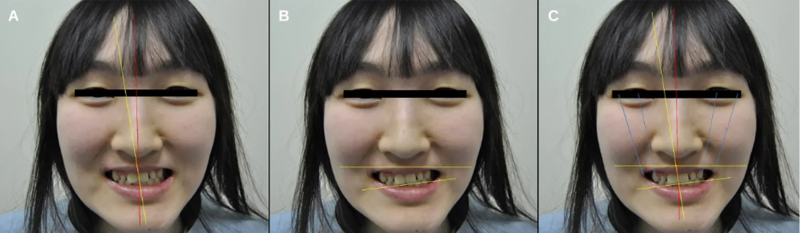 Fig. 18. Initial extra-oral photographs in frontal view. (A) Facial midline with the midline of central incisors, (B) Horizontal parameters relating the inter-pupillary line to the incisal edge position, (C) Full-facial analysis
