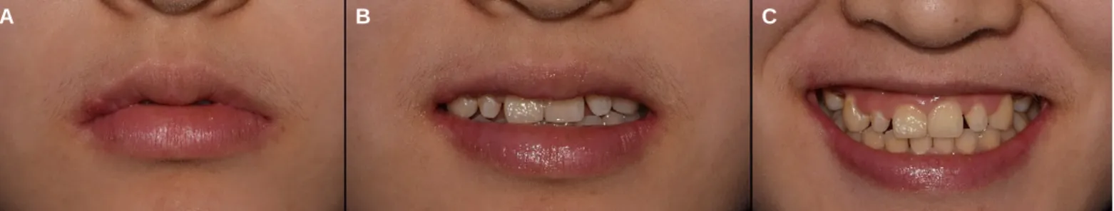 Fig. 22. Analysis of smile line at initial visit. (A) Rest state view, (B) Slight smile view, (C) Maximum smile view.