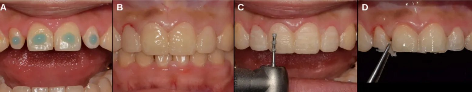 Fig. 26. Mock-up fabrication and abutment preparation. (A) Spot etching, (B) Mock-up fabircation, (C) Abutment preparation, (D) Removal of resin excess.