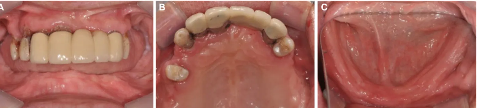Fig. 3. Interim denture delivery.