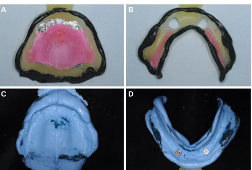 Fig. 6. Bolder molding and definitive impression taking. (A) Border molding for maxillary denture, (B) Border molding for mandibular denture, (C) Final impression tak- tak-ing of maxilla, (D) Final impression taktak-ing of mandible with impression coptak-i