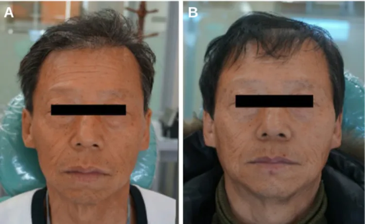 Fig. 13. Patient’ s profile. (A) Profile of first visit, (B) Profile of visit after final denture delivery.