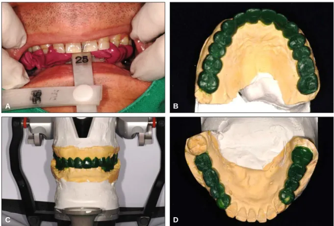Fig. 3. (A) The new VDO was set by 2.5 mm increase in the anterior teeth (using leaf gage), (B, C, D) Diagnostic wax-up was done on the new VDO.