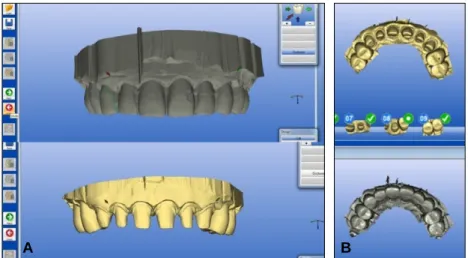 Fig. 6. Digitally overlap image of maxillary prepared and temporary teeth. (A) Frontal view, (B) Occlusal view.