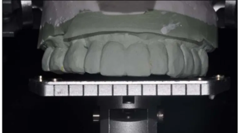 Fig. 5. 2 nd wax-up after cutback of the 1 st provisional restoration.