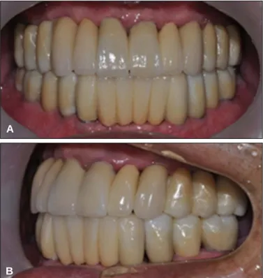 Fig. 8. Definitive restoration. (A) Frontal view, (B) Lateral view.