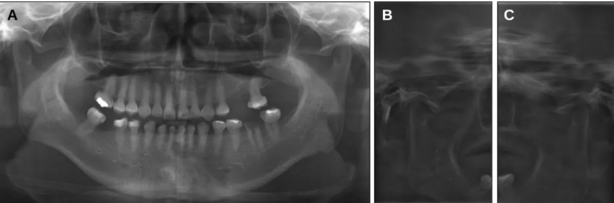 Fig. 1. Initial radiographs of the patient. (A) Panoramic radiograph, (B) Right TMJ panorama, (C) Left TMJ panorama.