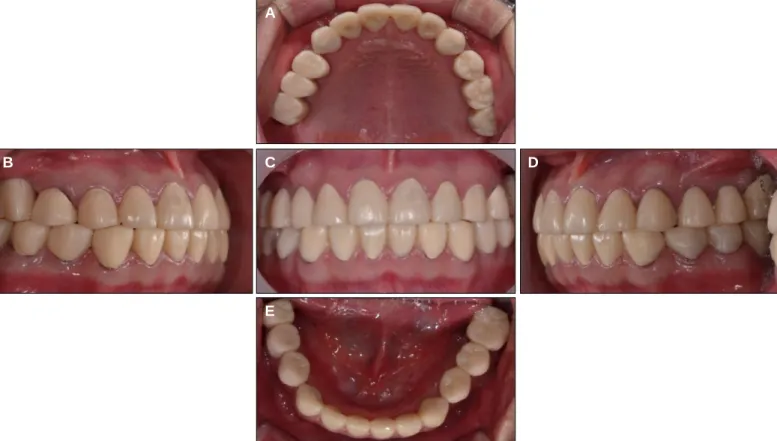 Fig. 3. Provisional Prostheses. (A) Maxillary occlusal view, (B) Lateral view (right), (C) Frontal view, (D) Lateral view (left), (E) Mandibular occlusal view.