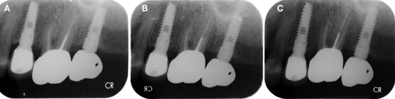 Fig. 3. Serial periapical image after soldering at mesial side of upper left 2 nd molar implant crown