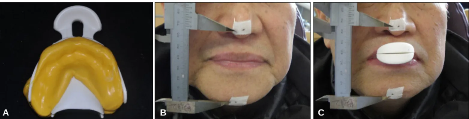 Fig. 4. Preliminary vertical dimension taking with Centric tray � . (A) Centric tray � , (B) Resting position, (C) Vertical dimension taking at resting position.