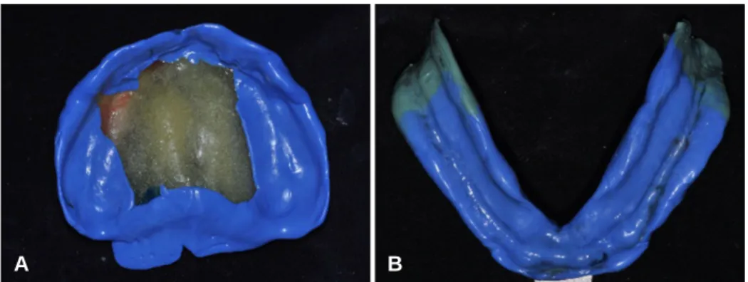 Fig. 7. Border molding with functional movement. (A) Border molding of maxilla, (B) Border molding of mandible.