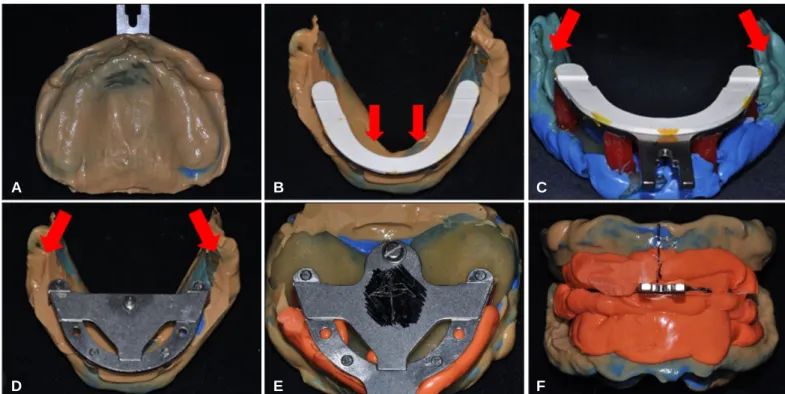 Fig. 9. Final impression taking and Gothic arch tracing. (A) Final impression of maxilla, (B) Final impression of mandible
