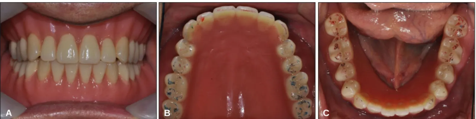 Fig. 13. Patient's profile. (A) Profile of first visit, (B) Profile after final denture delivery.