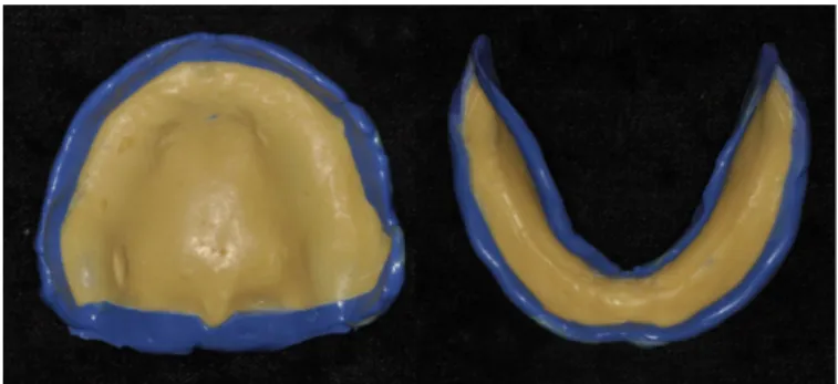 Fig. 5. Final impression taking using light body of Virtual regular set � .