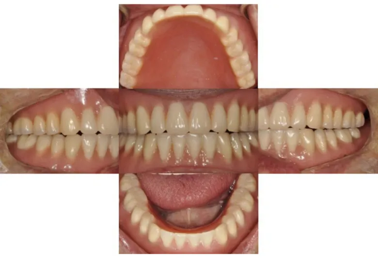 Fig. 8. BTC point on retromolar pad area of mandibular denture polishing surface.