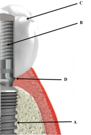 Fig. 1. Schematic diagram of submucosal zirconia implant prosthesis. (A) Internal connection fixture, (B) 1 mm cuff titanium abutment, (C) Screw cement retained prosthesis, (D) Prosthesis margin.