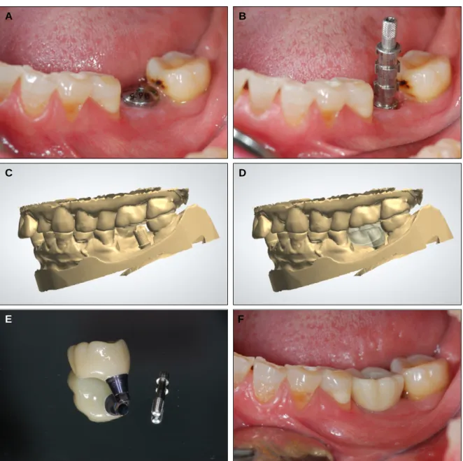 Fig. 2. Clinical pictures of case 1. (A) Intraoral view after implant surgery, (B) Pick-up impression coping, (C) Scanning of 1 mm cuff milled titanium abutment, (D) Computer aided design of submucosal prosthesis, (E) Submucosal zirconia implant prosthesis