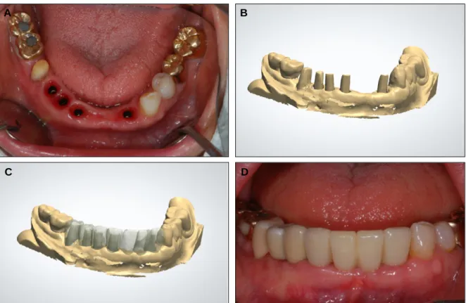 Fig. 3. Clinical pictures of case 2. (A) Occlusal view after implant surgery, (B) Scanning of milled titanium abutment, (C) Computer aided design of prosthesis, (D) Definitive prosthesis.