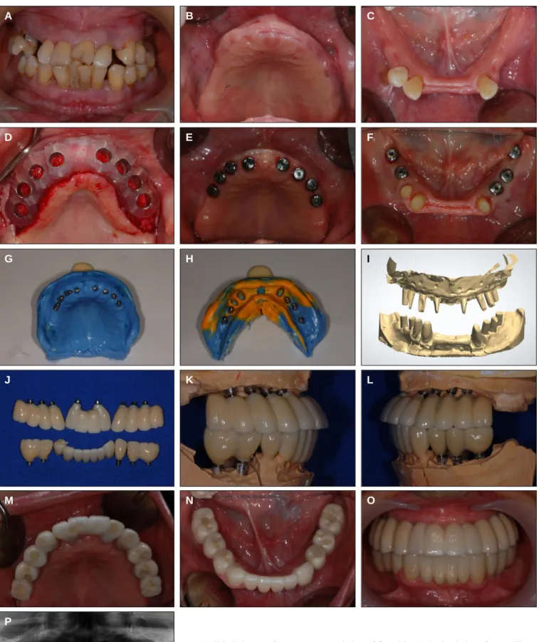 Fig. 4. Clinical pictures of case 3. (A) Frontal view of first visit, (B) Occlusal view after maxillary teeth extraction, (C) Occlusal view after mandibular teeth extraction, (D) SurgiGuide with SimPlant program, (E) Occlusal view after maxillary implants 