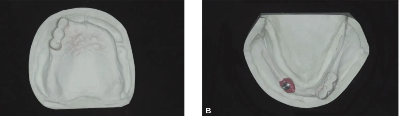 Fig. 3. Master cast fabrication. A: Upper master cast, B: Lower master cast with Locator male connection.