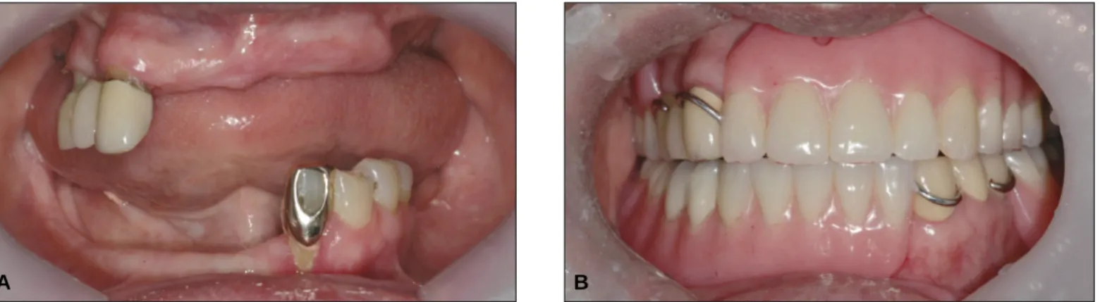 Fig. 6. Intraoral photo. A: At first visit, B: After final denture delivery.