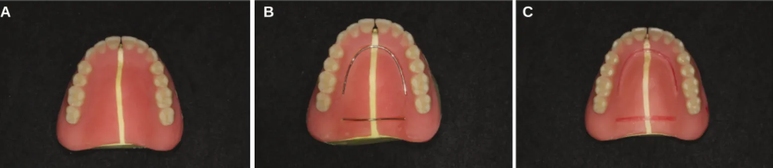 Fig. 2. Location of reinforcement materials in midline fracture of maxillary complete denture