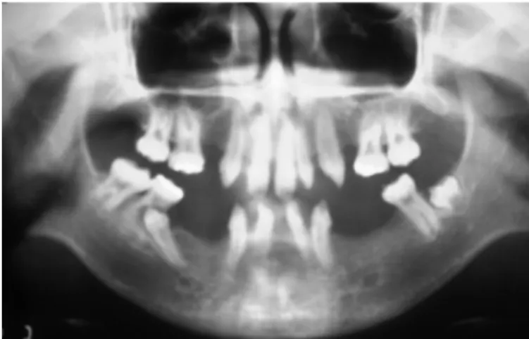 Fig. 1. Pre-operative panoramic radiograph (January 1999).