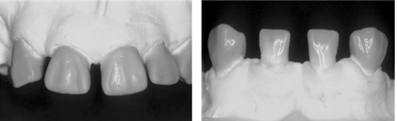 Fig. 3. Diagnostic wax-up with proper crown contour and ratio.