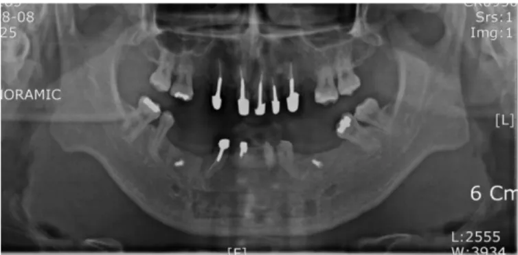Fig. 5. Panoramic radiograph after endodontic treatment on maxillary anterior teeth and bone graft on mandibular defect area