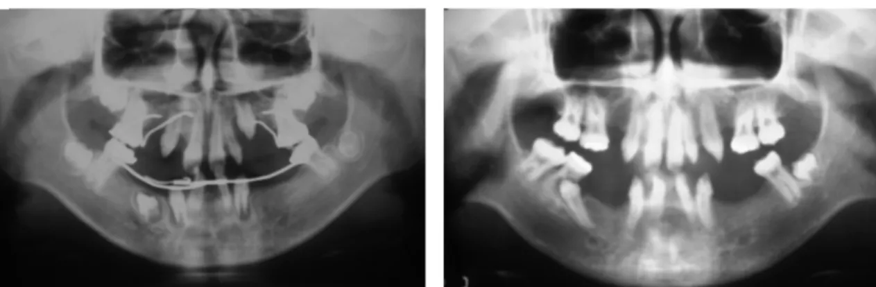 Fig. 11. Occlusal plane establishment considering clinical crown length of max- max-illary and mandibular central incisor, vertical and horizontal overlap, height of first molar and height of retromolar pad.