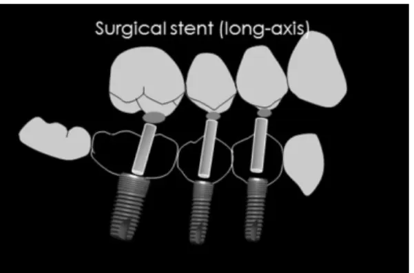 Fig. 12. Direction of implantation should be parallel to the long axis of opposing teeth.