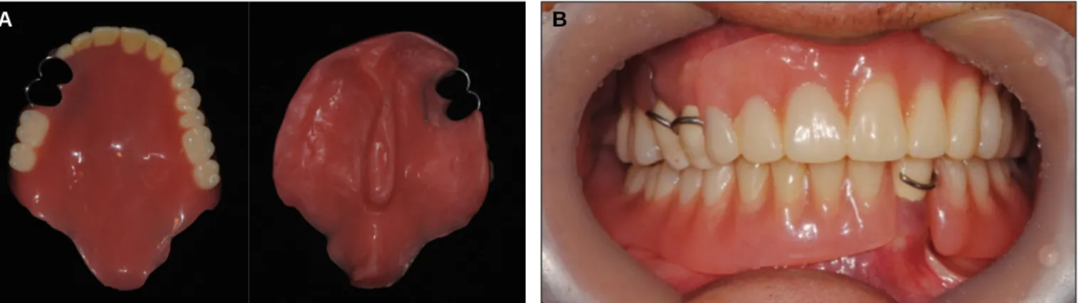 Fig. 2. A: Temporary denture, B: Intraoral photograph after the placement of temporary denture and crown.