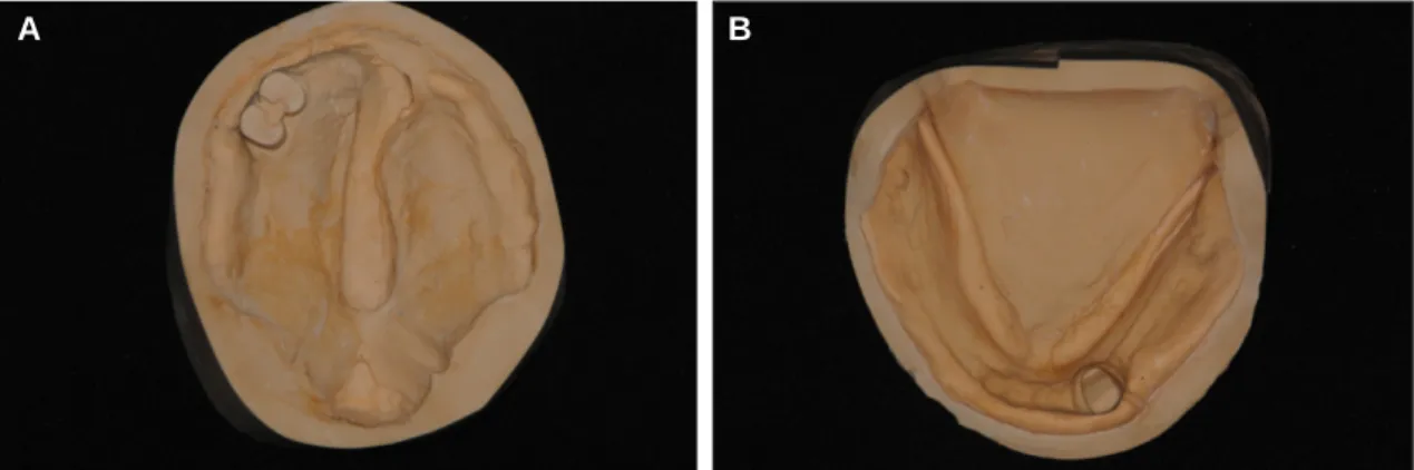 Fig. 4. Master cast. A: Upper master cast including velar and pharyngeal portion, B: Lower master cast.