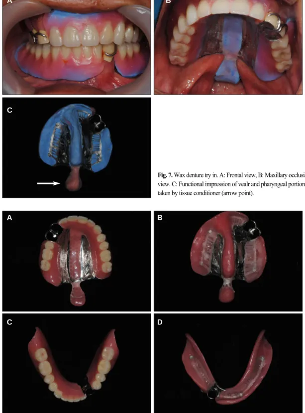 Fig. 7. Wax denture try in. A: Frontal view, B: Maxillary occlusial view. C: Functional impression of vealr and pharyngeal portions, taken by tissue conditioner (arrow point).