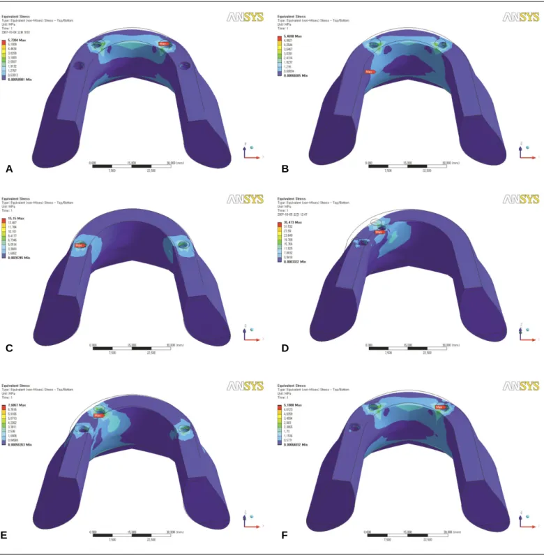Fig. 3. Stress distributions of LC1 on peri-implant bone. A: TH-I, B: TH-II, C: TH-III, D: TH-IV, E: TH-V, F: TH-VI