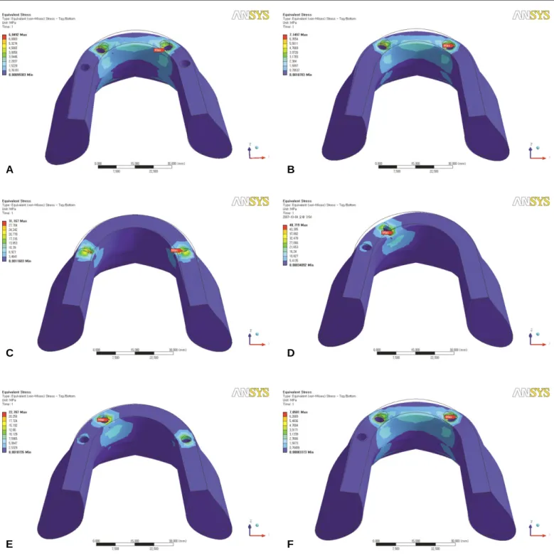 Fig. 6. Stress distributions of LC1 on peri-implant bone. A: IM-I, B: IM-II, C: IM-III, D: IM-IV, E: IM-V, F: IM-VI