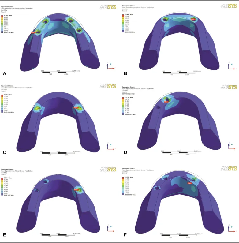 Fig. 7. Stress distributions of LC2 on peri-implant bone. A: IM-I, B: IM-II, C: IM-III, D: IM-IV, E: IM-V, F: IM-VI.
