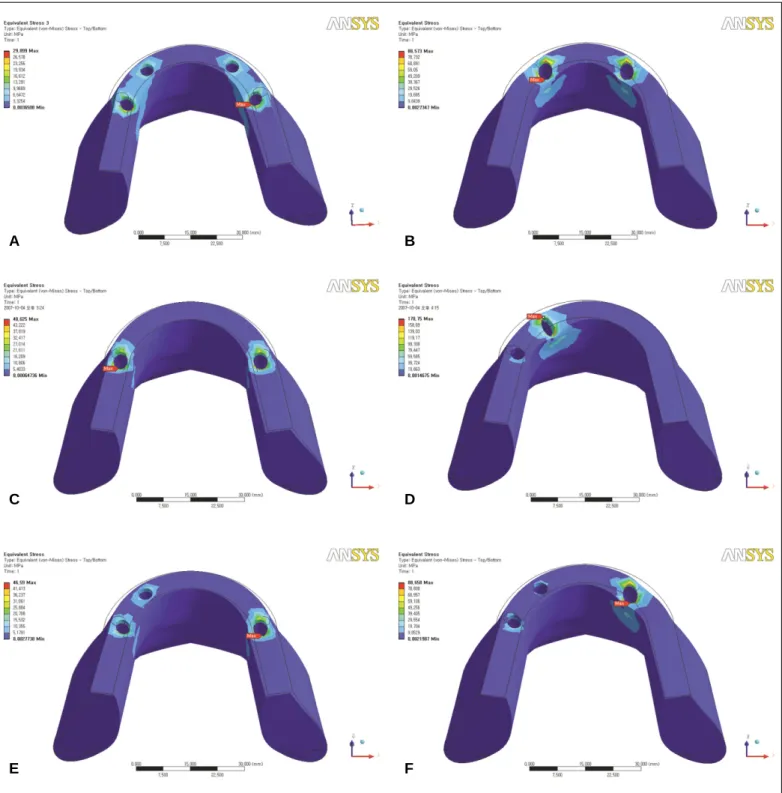 Fig. 8. Stress distributions of LC3 on peri-implant bone. A: IM-I, B: IM-II, C: IM-III, D: IM-IV, E: IM-V, F: IM-VI.