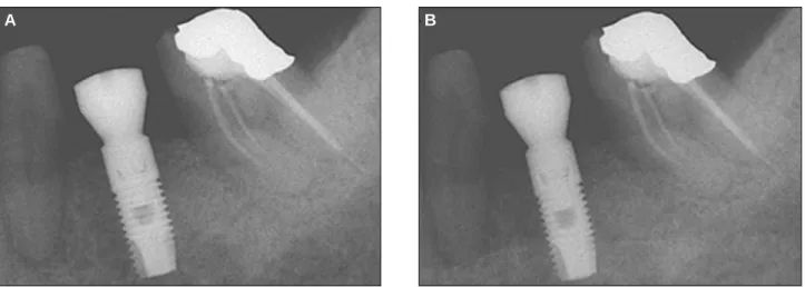 Fig. 3. A: Insertion, B: After 3 months. Periapical radiography with the use of customized XCP bite.