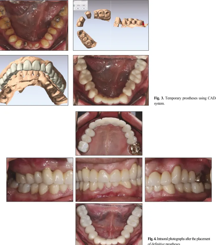 Fig. 3. Temporary prostheses using CAD/CAM system.