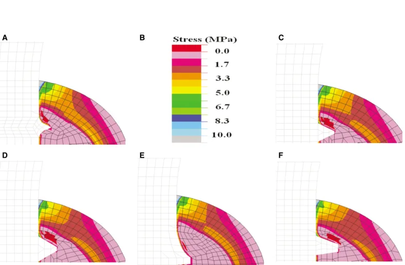 Fig. 4. Stress distributions (maximum compressive stress) in the marginal bone around the 5 implant models subject to a vertical load of 100 N