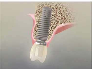 Fig. 2. Sealing around the soft tissue is excellent and adequate thickness could be maintained at the fixture-abutment interface in platform switching concept.
