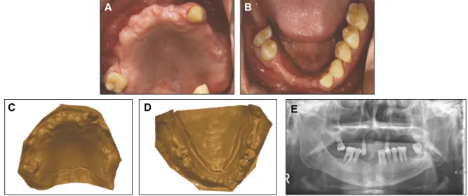 Fig. 1. Initial photograph of clinical case 1. A, B: initial occlusal view, C, D: the solid computer model of the patient’ s cast, E: initial panoramic view.